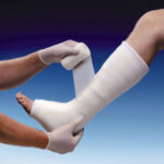 Synthetic cast 5.0X3.6